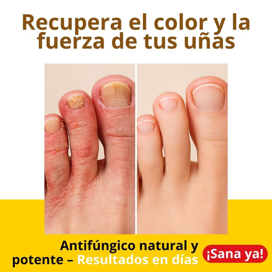 Aceite de Girasol Ozonizado Doctor Azono - Tratamiento Antifúngico