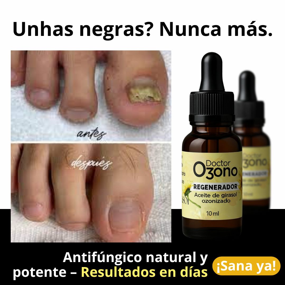 Tratamiento para Hongos de las uñas y pies - DoctorOzono