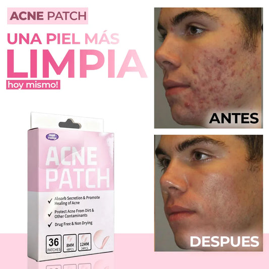 Súper Parches AntiAcne